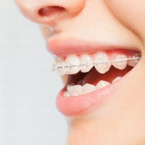 woman smiling with Six Month Smiles braces on her teeth