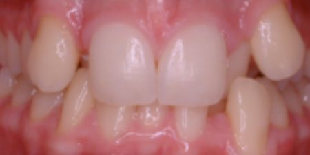 Teeth – before